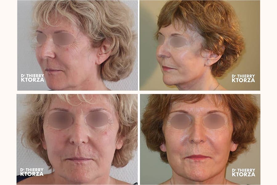 deep plance facelift avant apres dr thierry ktorza chirurgie esthetique paris deep plance facelift avant apres dr thierry ktorza chirurgie esthetique paris