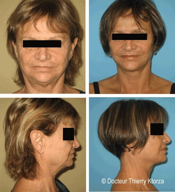 lifting-cervicofacial-avant-apres-correction-ovale-visage lifting-cervicofacial-avant-apres-correction-ovale-visage