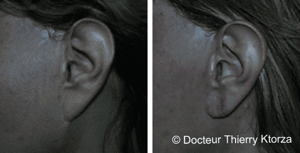 lifting-cervicofacial-lobe-oreille lifting-cervicofacial-lobe-oreille