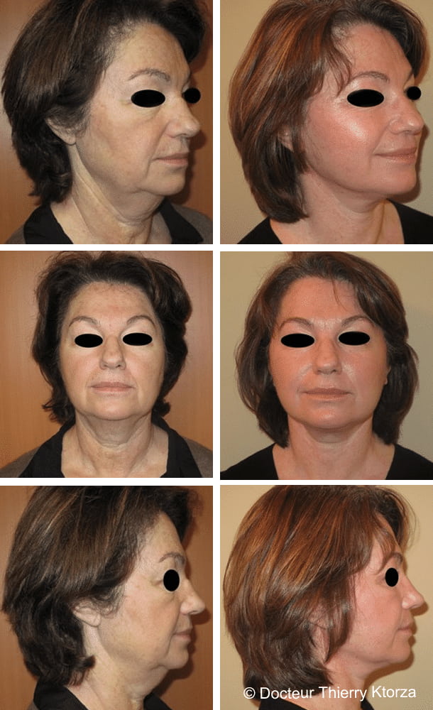 lifting-cervicofacial-photo-avant-apres lifting-cervicofacial-photo-avant-apres