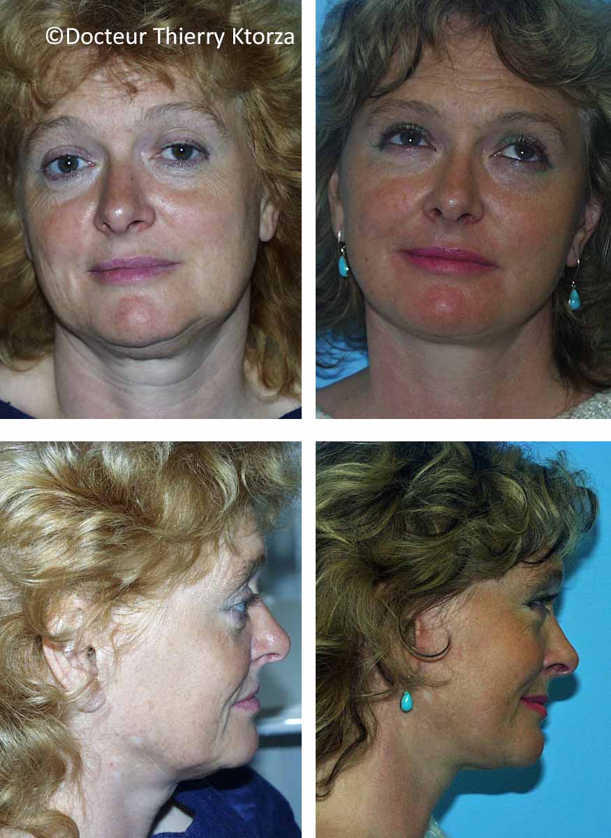 lifting-visage-femme-50-ans lifting-visage-femme-50-ans