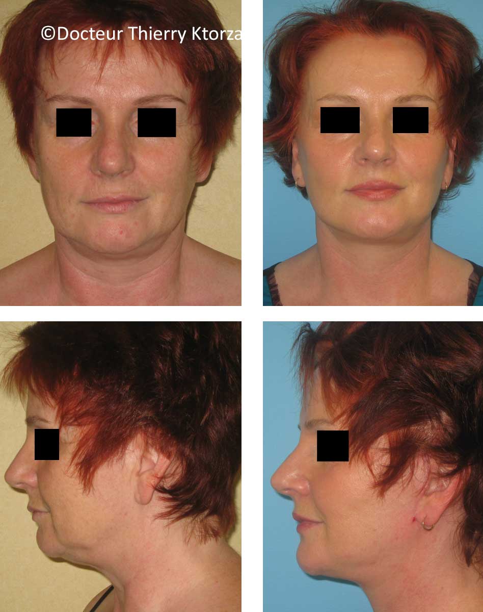 lifting-visage-femme-56-ans lifting-visage-femme-56-ans