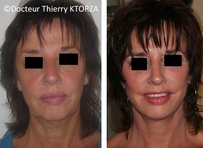 lifting-visage-femme-58-ans lifting-visage-femme-58-ans
