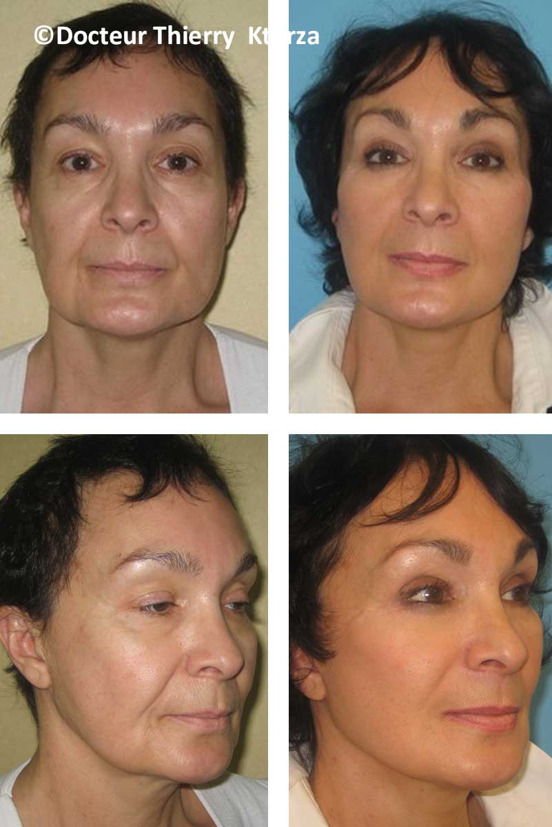 lifting-visage-femme-59-ans lifting-visage-femme-59-ans