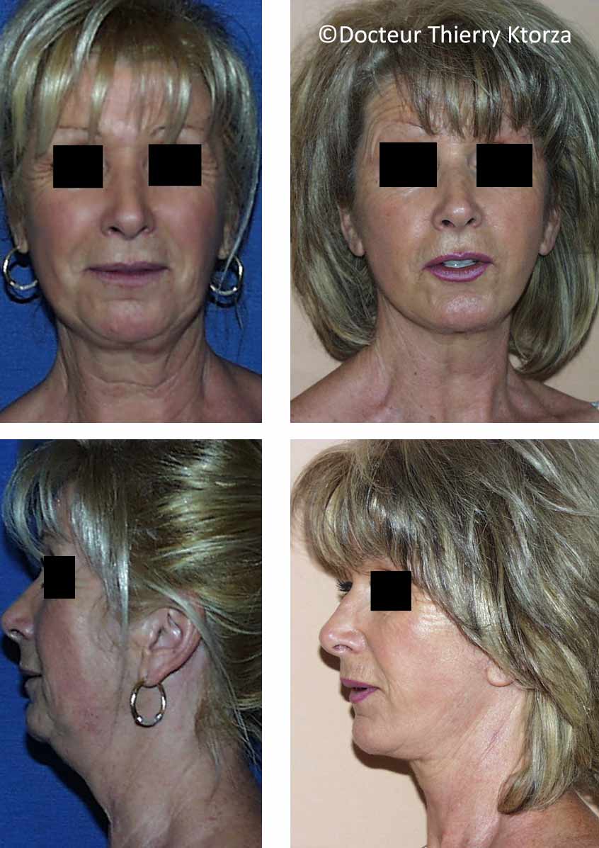 lifting-visage-femme-61-ans lifting-visage-femme-61-ans