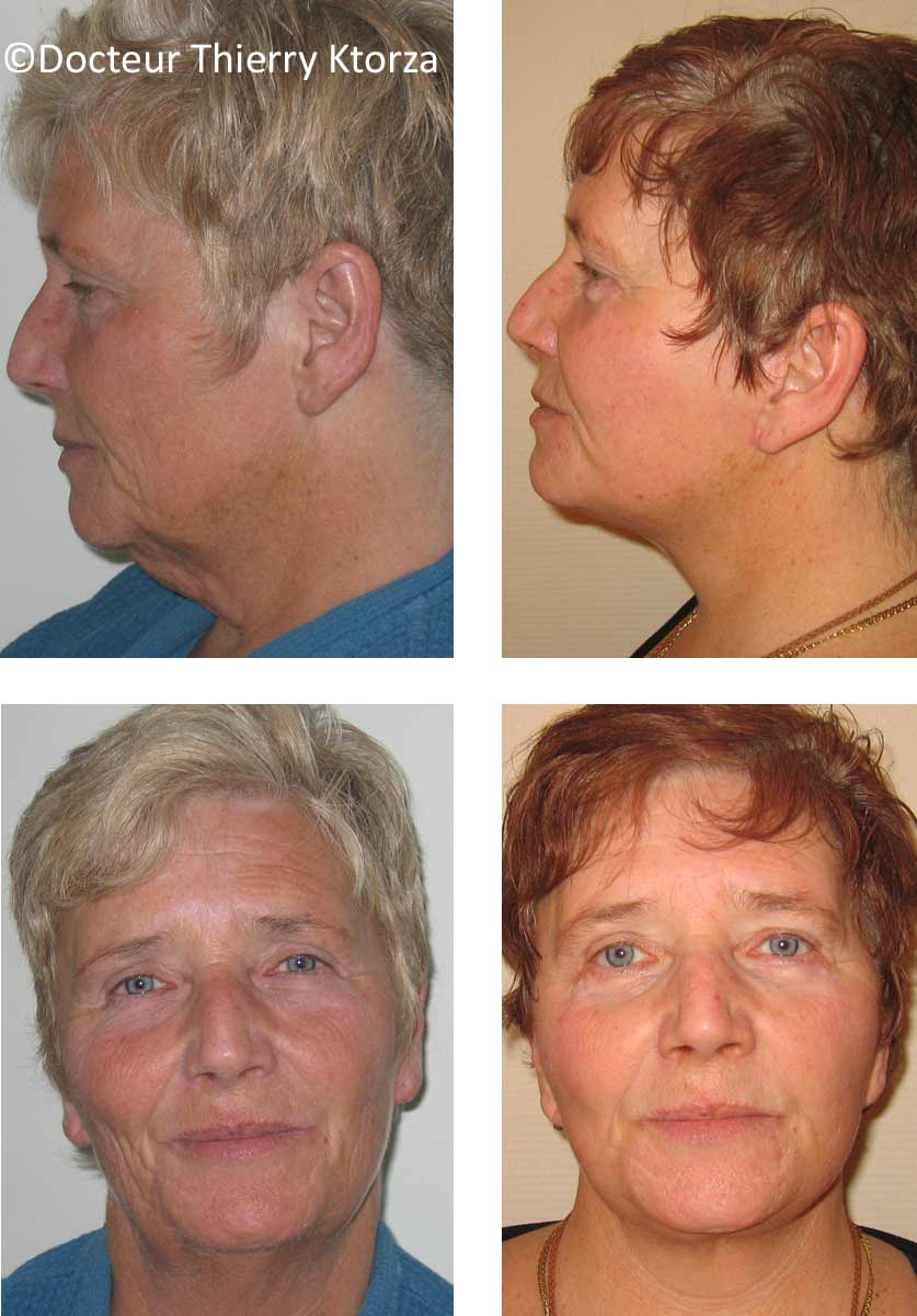 lifting-visage-femme-66-ans lifting-visage-femme-66-ans