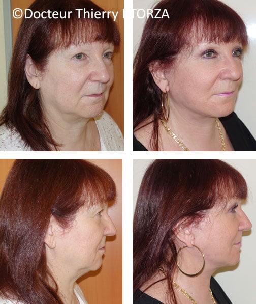 lifting-visage-femme-paupiere lifting-visage-femme-paupiere