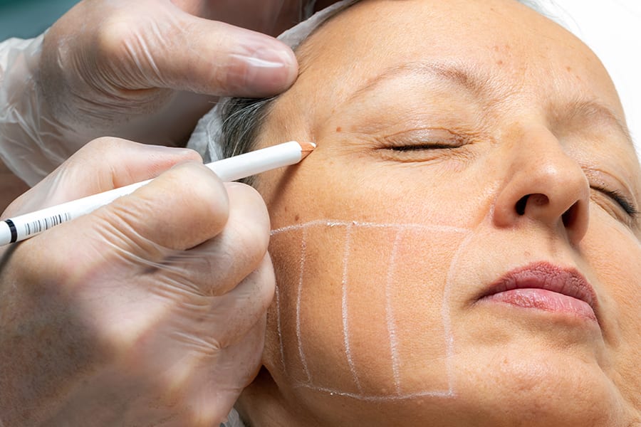 choisir meilleur chirurgien lifting visage prix lifting visage avis chirurgien estetique resultat lifting cervico facial chirurgie esthétique dr thierry ktorza chirurgien lifting visage paris